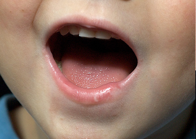 photography of mouth injury