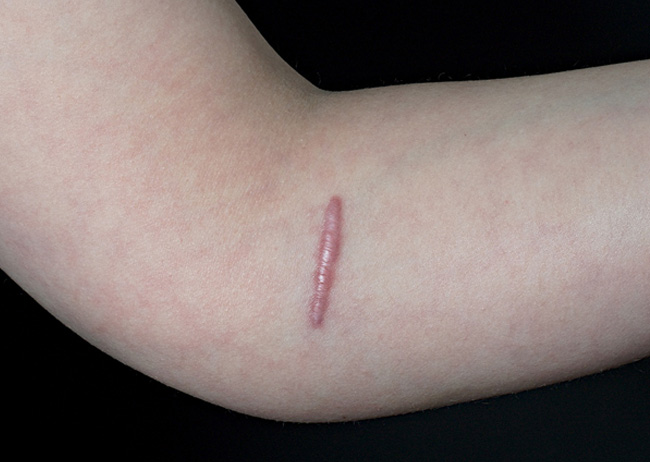 scarring injury to arm